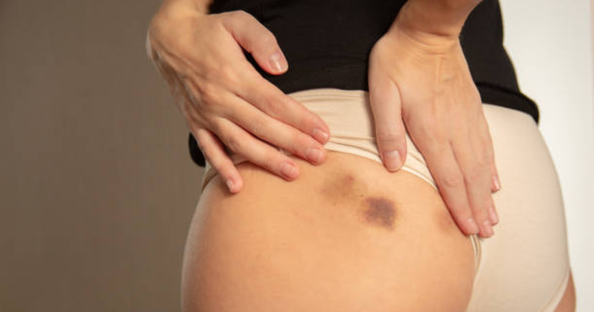 Dark Spots on Buttocks