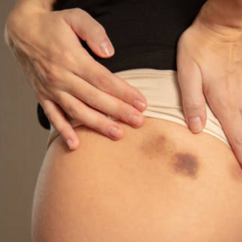 Dark Spots on Buttocks