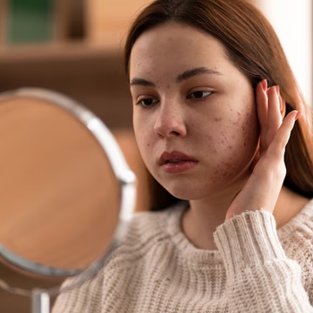 Hormonal Acne and Bacterial Acne