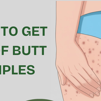 How to Get Rid of Butt Pimples – 10 Effective Tips