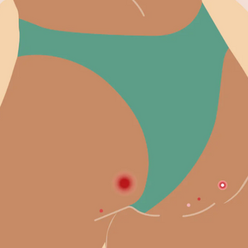 Say Goodbye to Butt Pimples: 5 Easy Skin Care Tips